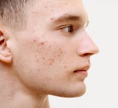 How to tackle Acne with supplements