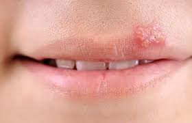 Cold Sores and how to treat them effectively with supplements.