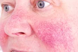 Help with Rosacea