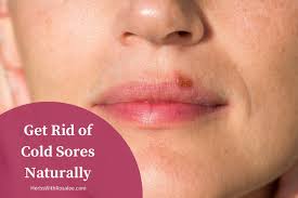 Dealing with Cold Sores Naturally.